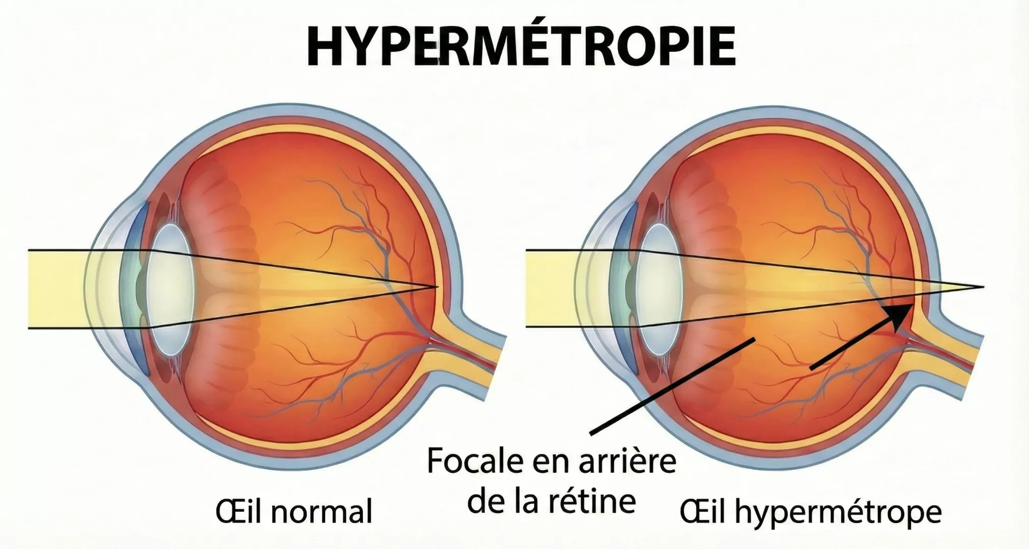 Illustration L'opération de l'hypermétropie - section 2