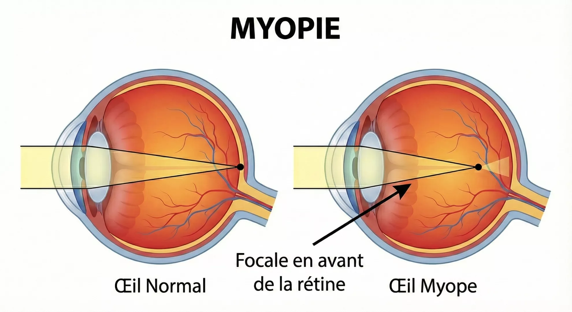Illustration L'opération de la myopie - section 2