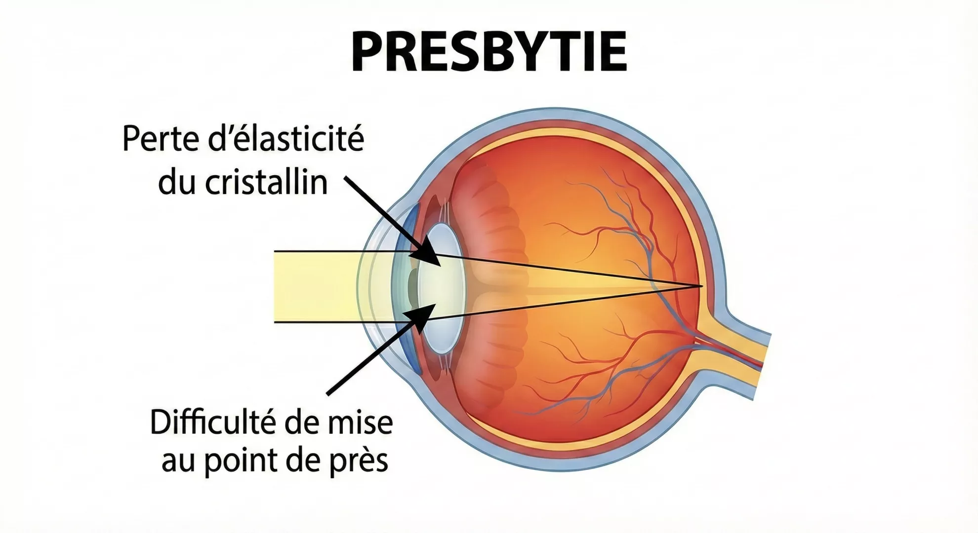 Illustration L'opération de la presbytie - section 2